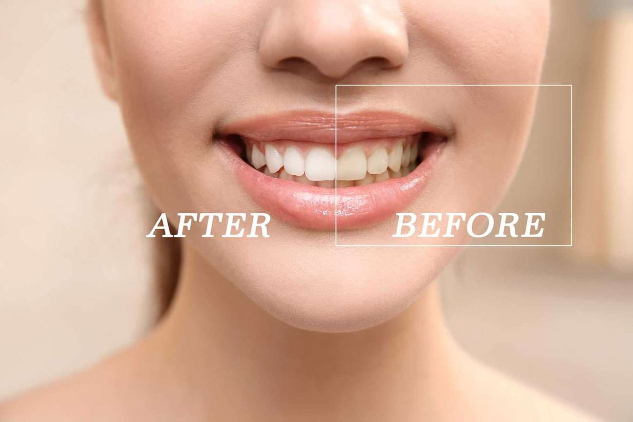 How Can You Maintain a Consistent Smile Shade with Crowns Swindon?