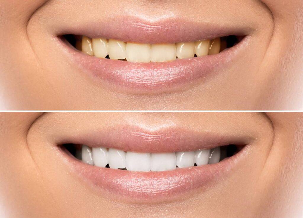 How Does Gum Disease Progress if Left Untreated Swindon?