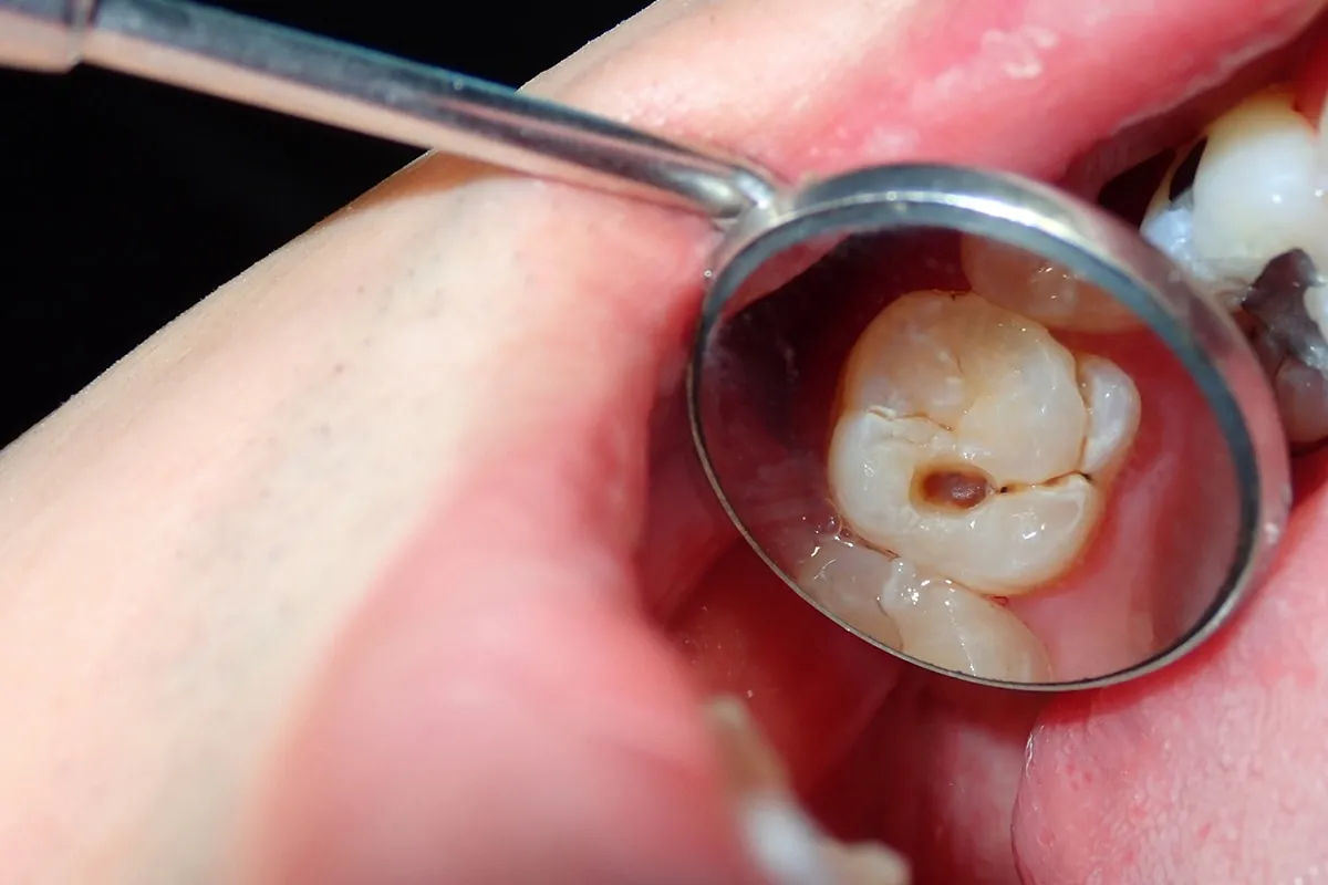 Why Do Teeth Crack? Common Causes to Know Swindon
