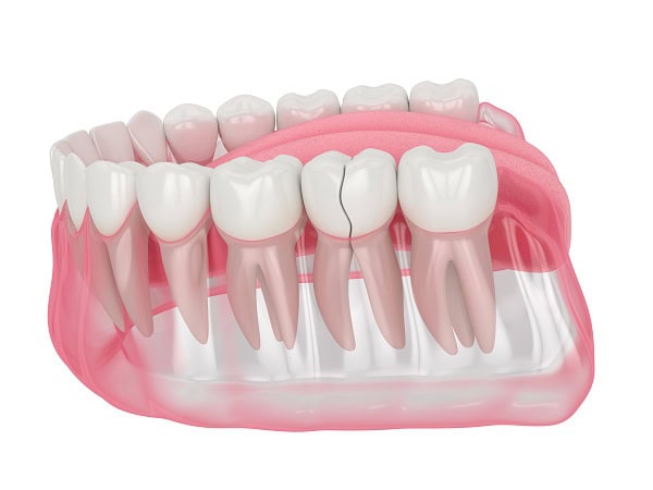 How Can You Manage Pain and Discomfort After a Root Canal Swindon?