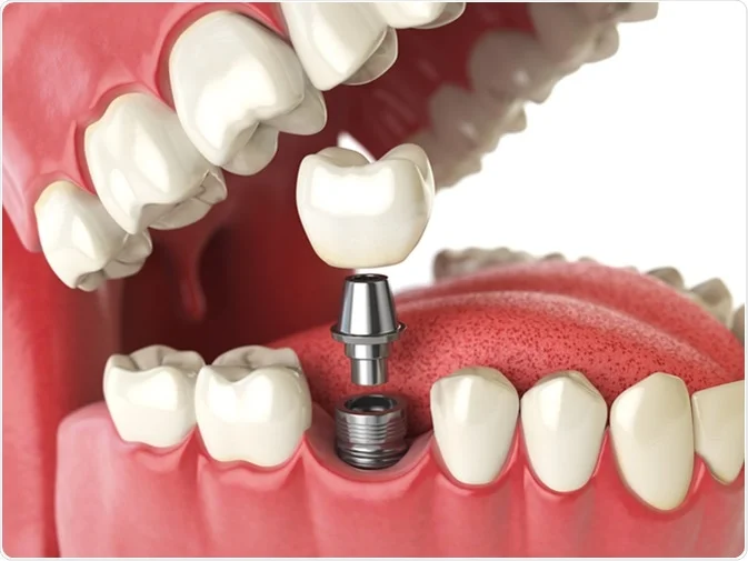 How Do I Decide Which Tooth Replacement Is Right for Me Swindon?