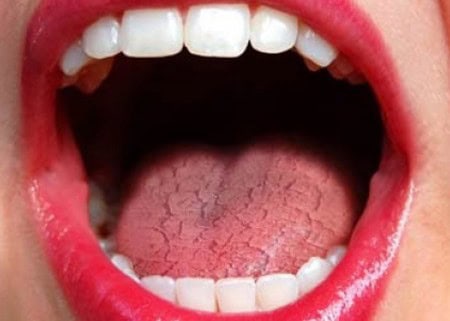 Common Causes of Dry Mouth (Xerostomia) Swindon