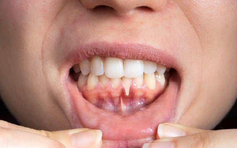 How Can Gum Disease Be Prevented Swindon?