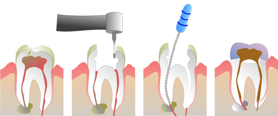 How Do You Properly Care for Your Teeth After a Root Canal Swindon