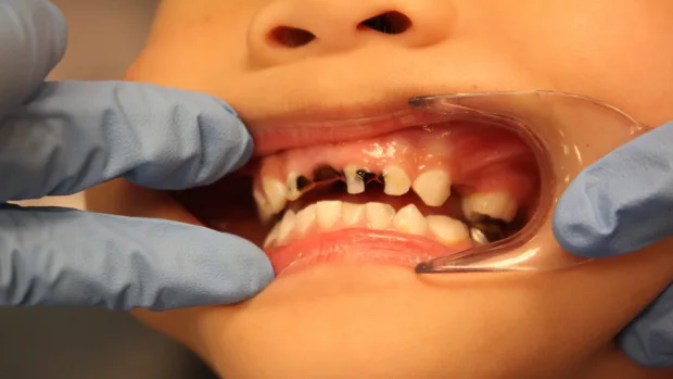 Tips for Keeping Your Child’s Baby Teeth Healthy and Strong Swindon
