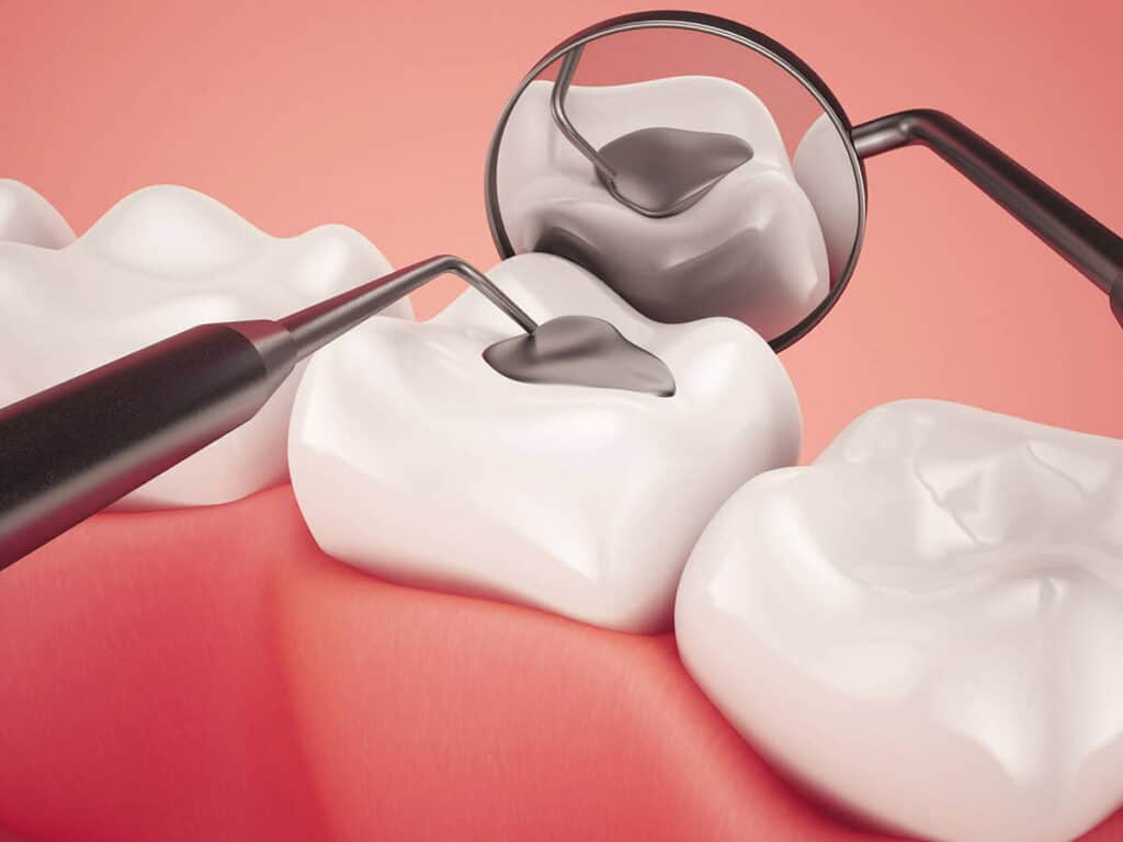 How Can You Prevent Tooth Decay Effectively Swindon