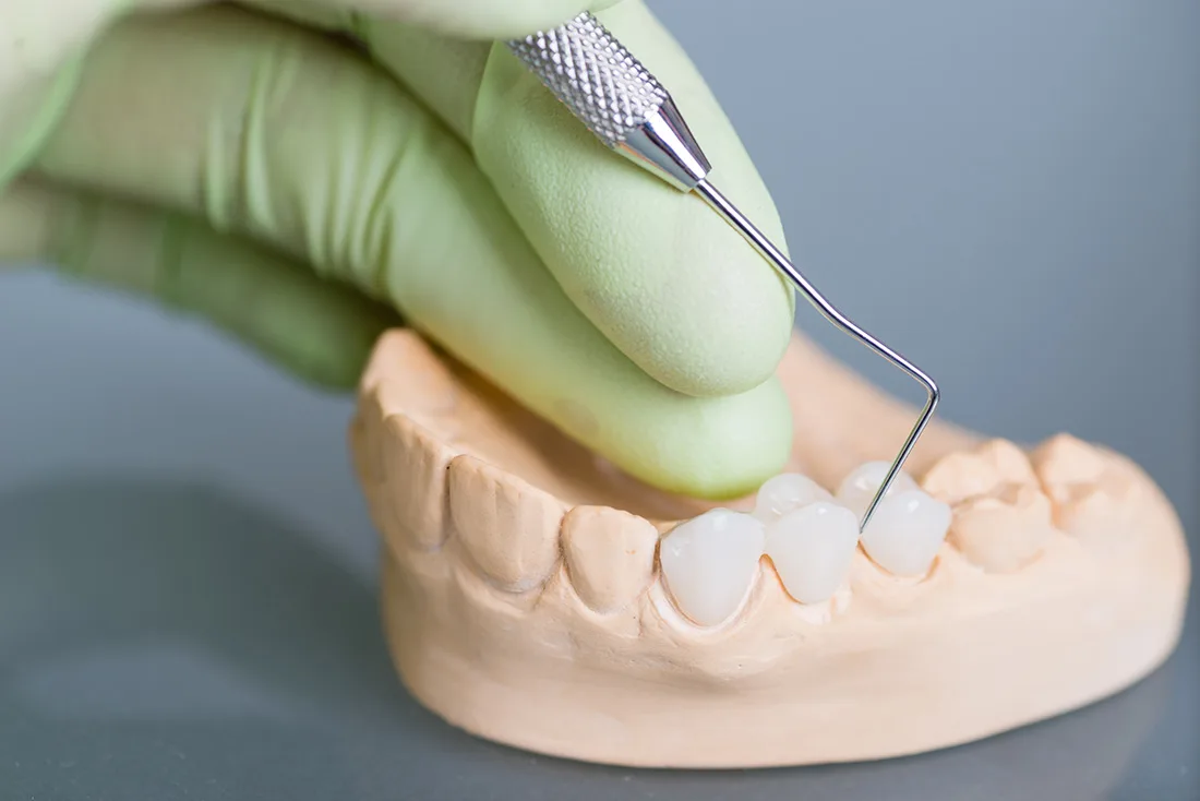 What Are the Different Types of Dental Crowns Available Swindon?