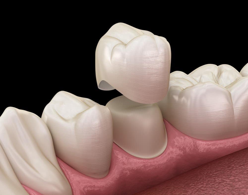 What is the Procedure for Getting Dental Implants Swindon?