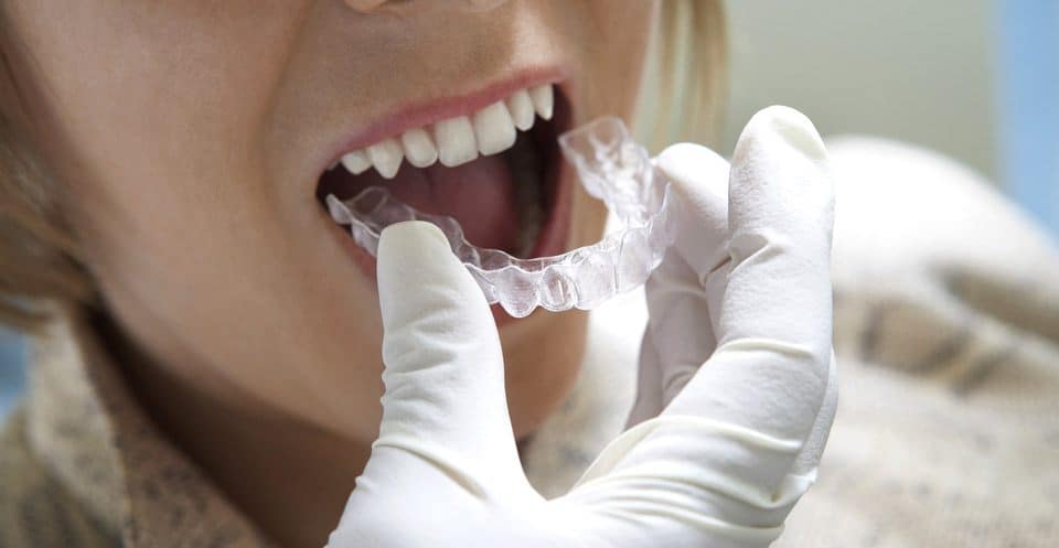 Why Bleaching Trays Require More Time Swindon